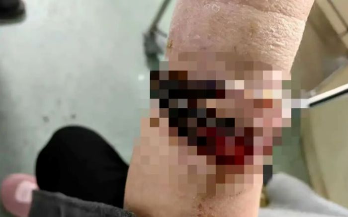 Đeo vòng tay suốt 10 năm không tháo, người phụ nữ 33 tuổi gặp sự cố kinh hoàng