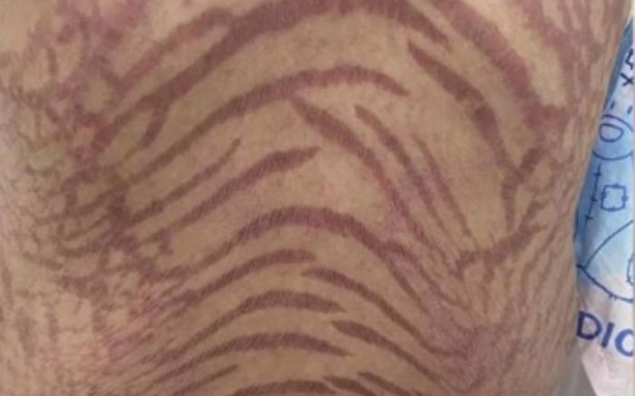 Bôi thuốc mỡ mua trên mạng suốt 10 năm, người phụ nữ bị biến dạng làn da