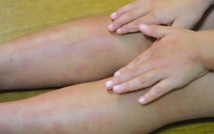 Bé gái 4 tuổi mắc bệnh giang mai, nguyên nhân đến từ thói quen của bà nội