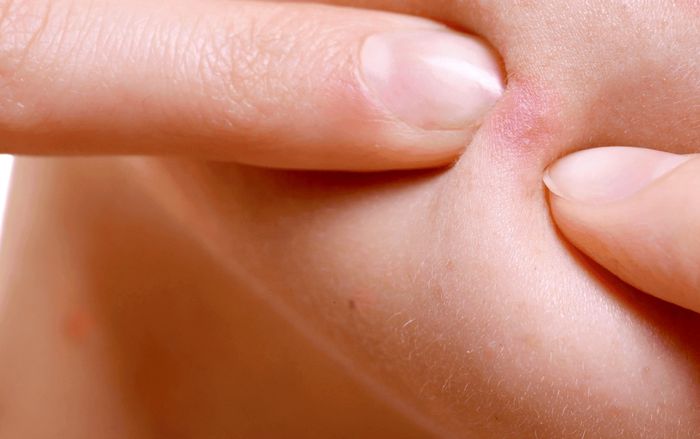 Nặn một nốt mụn trên mặt, người phụ nữ phải 'trả giá' đắt