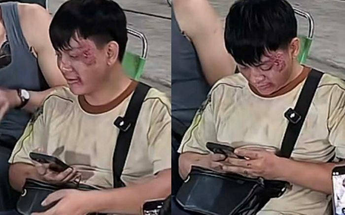 Hoài Lâm thương tích đầy mặt gây xôn xao