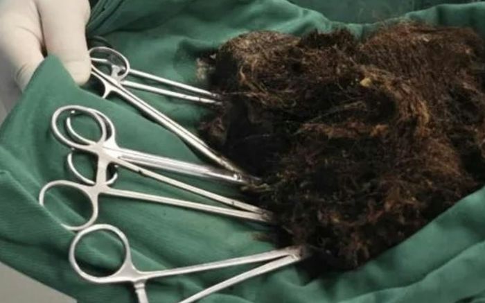 Ăn tóc suốt 20 năm, cô gái khiến dư luận 'dậy sóng' khi bác sĩ lấy ra 'tảng đá' nặng 1kg trong dạ dày