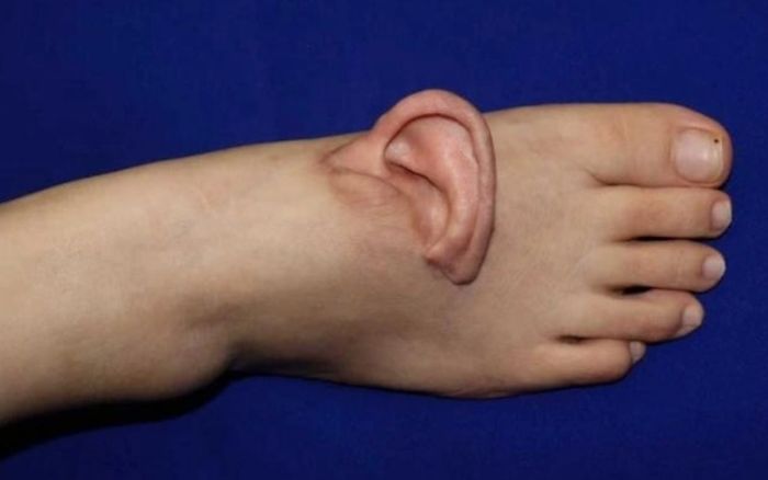 Cô gái có lỗ tai 'mọc' trên mu bàn chân, sự việc đằng sau khiến nhiều người nể phục