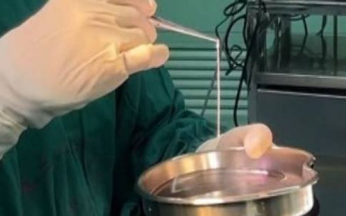 Người đàn ông bị động kinh hơn 20 năm, bác sĩ bàng hoàng khi phát hiện thứ bên trong não