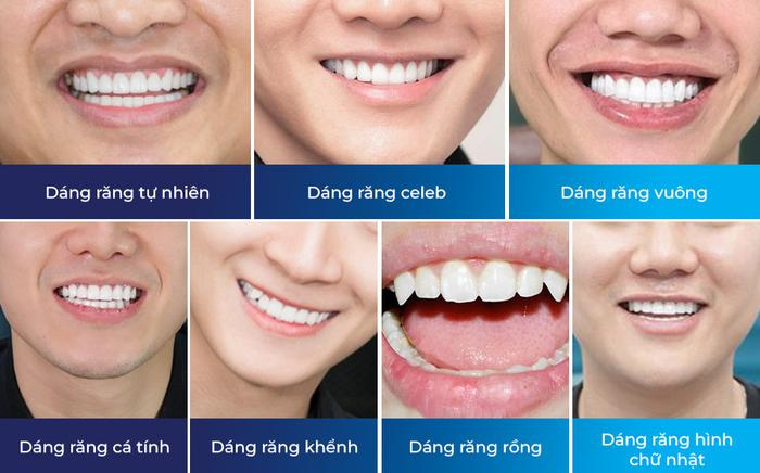 Top 7 dáng răng sứ nam đẹp được ưa chuộng nhất hiện nay