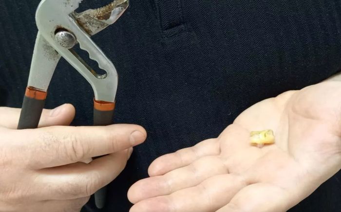 Tự nhổ răng bằng cờ lê, người đàn ông gặp biến chứng nặng