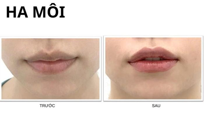 Làm đẹp thông minh cùng chất làm đầy Hyaluronic Axit