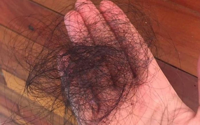 Bé gái lén ăn tóc của mình suốt một năm, gia đình đưa đi siêu âm thì thấy dị vật hình thành trong bụng