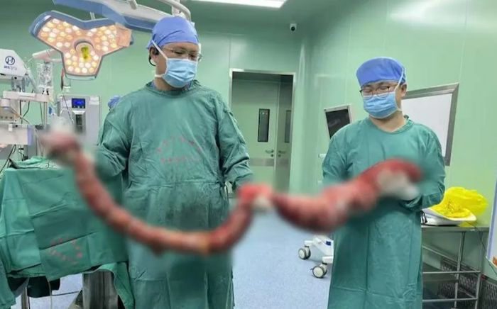 Người đàn ông không đi đại tiện suốt 4 tháng, bác sĩ phẫu thuật lấy ra khối ruột nặng hơn 20kg
