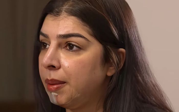 Người phụ nữ sốc vì diện mạo như 'quái vật' hậu tiêm filler