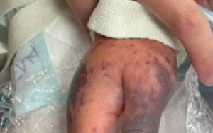 Bị ho sốt liên tục mà không khám, bé gái được chẩn đoán nhiễm 'vi khuẩn ăn thịt người'