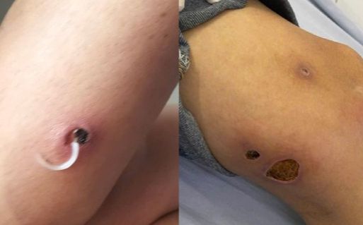 Cảnh báo bệnh 'giun rồng' hiếm gặp đã xuất hiện, ai có thói quen này hãy bỏ ngay
