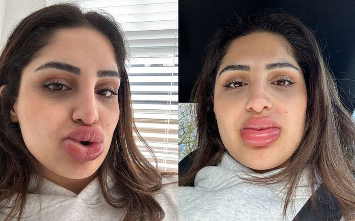 Người phụ nữ tiêm tan chất làm đầy khiến đôi môi sưng to như muốn 'nổ tung'