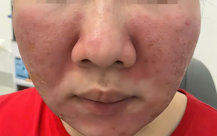 Nữ sinh bị hủy hoại gương mặt vì mua kem chống nắng trên mạng với giá 95.000 đồng