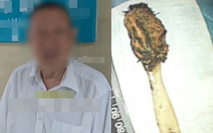 Khó tin người đàn ông sống với chiếc bàn chải trong cơ thể suốt 52 năm