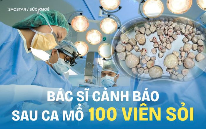 Bác sĩ cảnh báo sau ca mổ lấy 100 viên sỏi, hãy làm ngay việc này vào buổi sáng