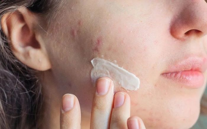 Nữ sinh 15 tuổi tử vong sau khi tự nặn mụn