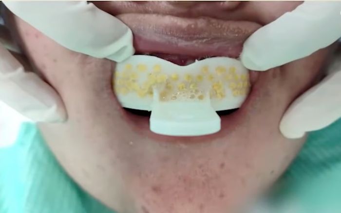 Tự làm hàm duy trì tại nhà, cô gái 24 tuổi gặp nguy hiểm đến tính mạng