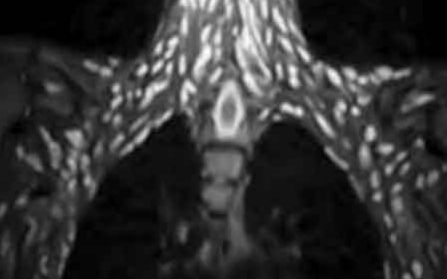 Ăn rau sống, cô gái bị sán dây lợn 'xâm chiếm' cơ thể