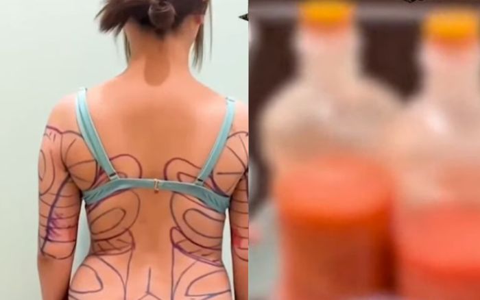 Nữ ca sĩ gây sốc khi chi 500 triệu đồng hút mỡ toàn thân, nhìn ảnh ai cũng 'lạnh người'