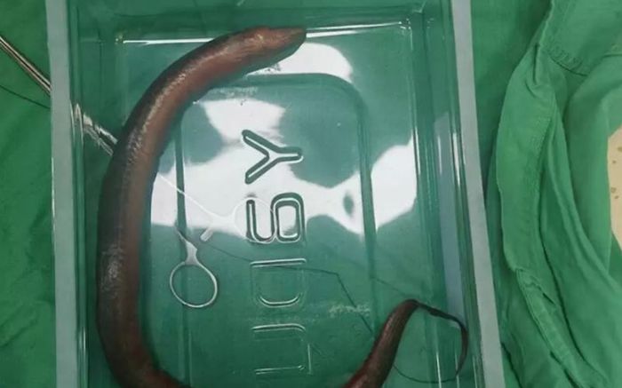 Con lươn 30cm chui vào bụng đâm thủng ruột người đàn ông, bác sĩ toát mồ hôi khi lấy ra