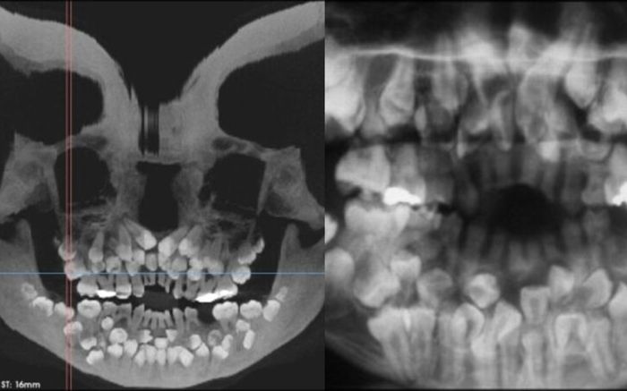 Bé gái 11 tuổi mọc 81 chiếc răng