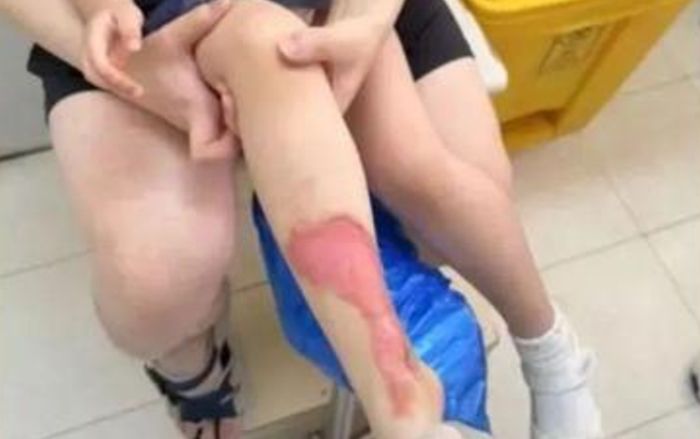 Ấm nước sôi bị gãy quai làm bé gái 3 tuổi bị bỏng nặng, nhà hàng xử lý gây bức xúc