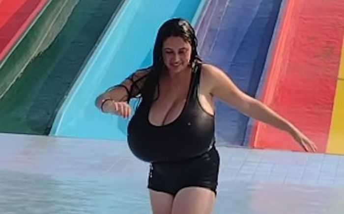 Cô gái mắc bệnh lạ khiến ngực to ra khổng lồ, nặng đến 12 ký