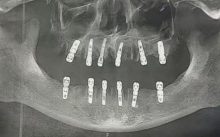 Cụ ông 77 tuổi tử vong sau khi cấy 6 implant và nhổ 12 răng