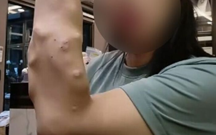 Cánh tay của cô gái trẻ bị suy thận giai đoạn cuối khiến nhiều người sững sờ