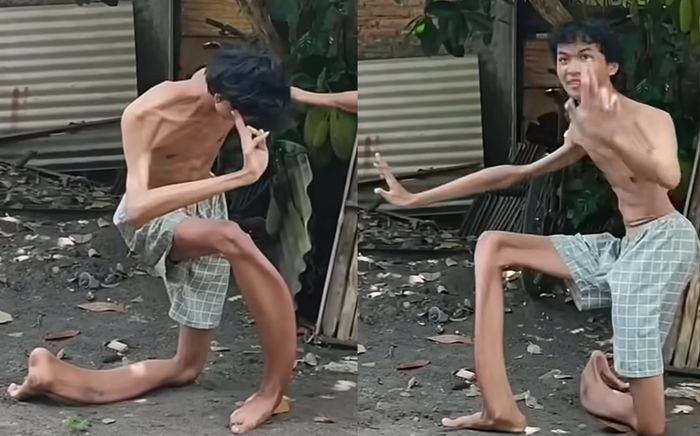 Chàng trai mắc căn bệnh từ trong bụng mẹ, đôi chân biến dạng như thanh kiếm gây ngỡ ngàng