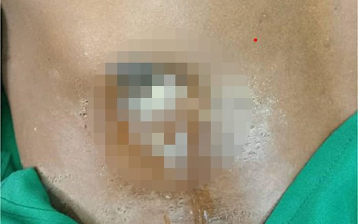 Ngực liên tục chảy ra chất dịch, người đàn ông đi bệnh viện thì phát hiện bí mật kinh hoàng suốt 8 năm