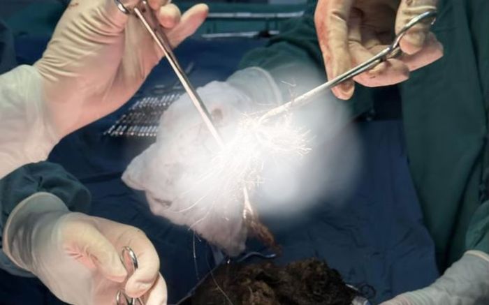 Đi khám vì đau bụng, bé gái khiến bác sĩ kinh ngạc với khối dị vật nặng 2kg bên trong