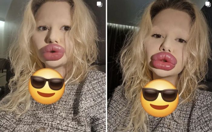 Cô gái có 'đôi môi lớn nhất thế giới' gây xôn xao với diện mạo mới