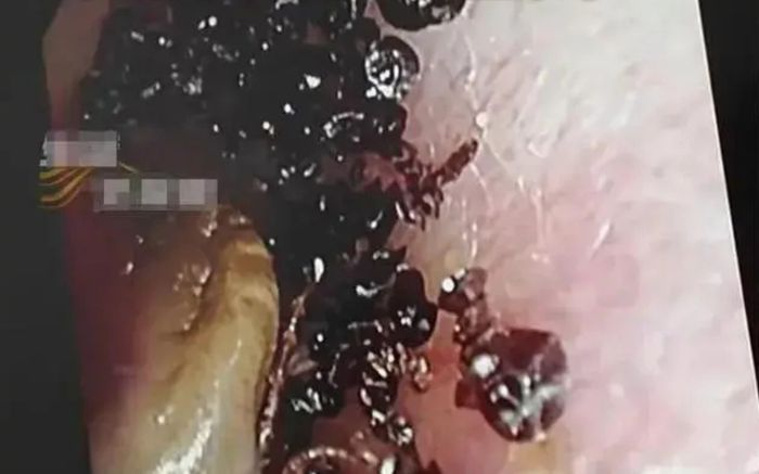 Nhập viện vì đau tai, bác sĩ sốc nặng khi nhìn thấy thứ ẩn trong tai bé gái 2 tuổi