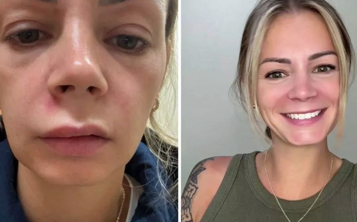 Người phụ nữ nhập viện cấp cứu vì nặn mụn ở vùng da nguy hiểm