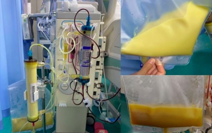 Cô gái 27 tuổi nguy kịch, máu trắng đục vì uống một loại nước quen thuộc mỗi ngày