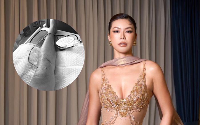 Siêu mẫu Minh Tú phải phẫu thuật sau chấn thương nghiêm trọng
