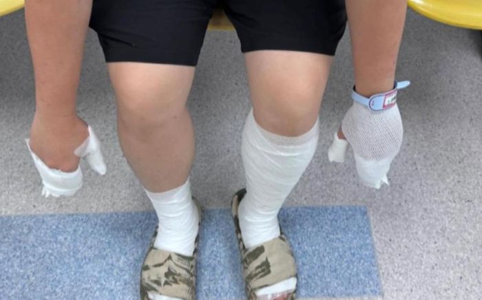 Người đàn ông bị bỏng cấp độ hai toàn thân khi sử dụng thuốc xịt côn trùng