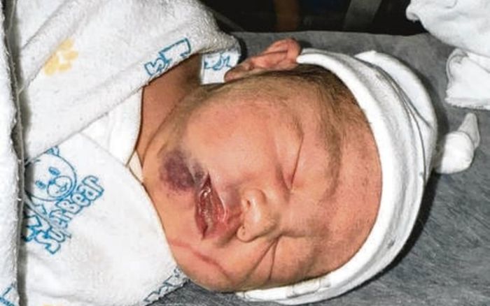 Khuôn mặt bé trai bầm tím nghiêm trọng sau khi sinh, cha mẹ đau lòng