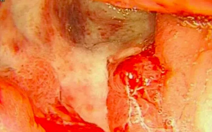 Nữ diễn viên nôn ra máu khi đang quay phim, nhập viện khẩn cấp thì phát hiện bị ung thư dạ dày