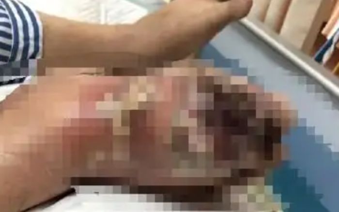 Uống ba lon nước ngọt mỗi ngày trong nhiều năm, người đàn ông 31 tuổi gặp tình trạng kinh hoàng ở bàn chân