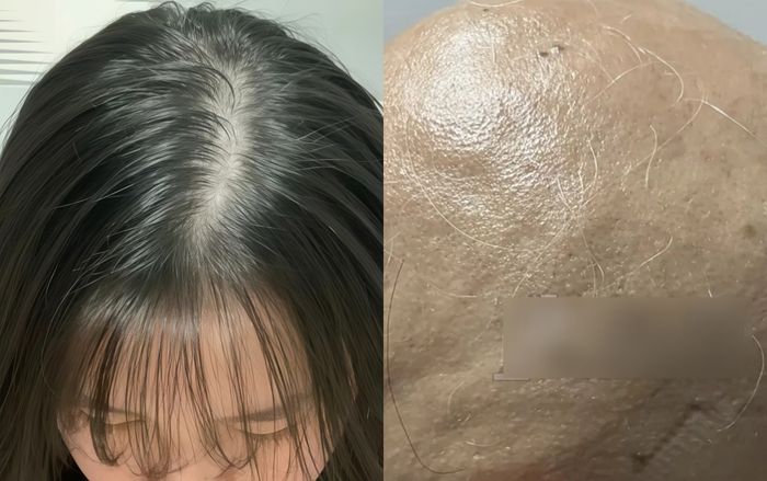 Chia tay người yêu, cô gái rụng sạch tóc và lông mày chỉ trong 1 tháng