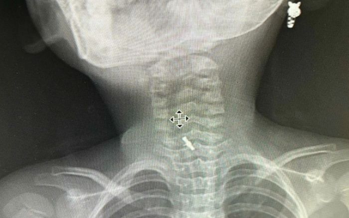 Dị vật kẹt họng khiến bé gái 5 tuổi phải cấp cứu khẩn