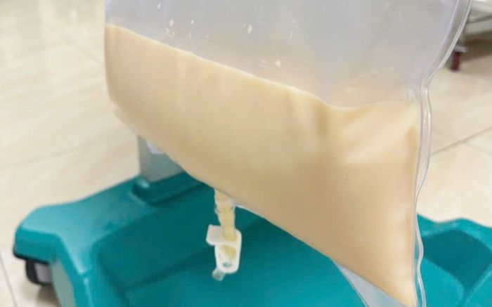 Người đàn ông 46 tuổi nhập viện trong tình trạng đau bụng, lọc mỡ máu trắng đục như sữa