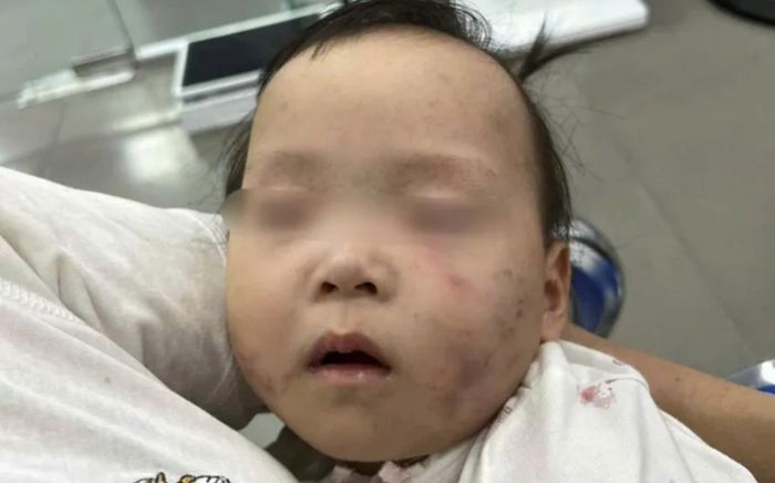 Bé gái 1 tuổi bầm tím mặt khi gửi nhà trẻ, mẹ bức xúc trình báo Công an: Bảo mẫu bị tạm giữ