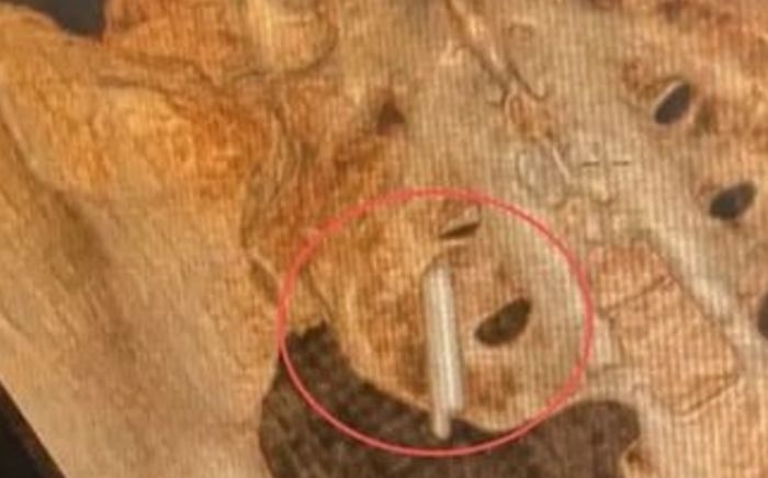 Đi khám sức khỏe, cô gái phát hiện vật dài khoảng 2cm trong cơ thể suốt 22 năm