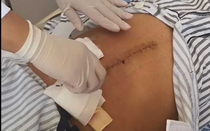Chàng trai hiến gan cứu con gái, xuất viện sớm và tự thay băng hậu phẫu thuật để tiết kiệm tiền