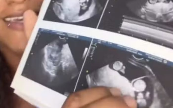 Đang mang thai, người phụ nữ 24 tuổi nhận cú sốc khó tin khi đi siêu âm