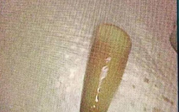 Nam thanh niên 24 tuổi nhập viện vì ho ra máu, bác sĩ nội soi thì phát hiện thứ bị mắc kẹt bên trong